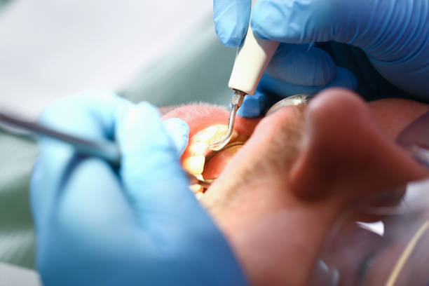 Best Emergency Wisdom Teeth Removal in Buckhall, VA